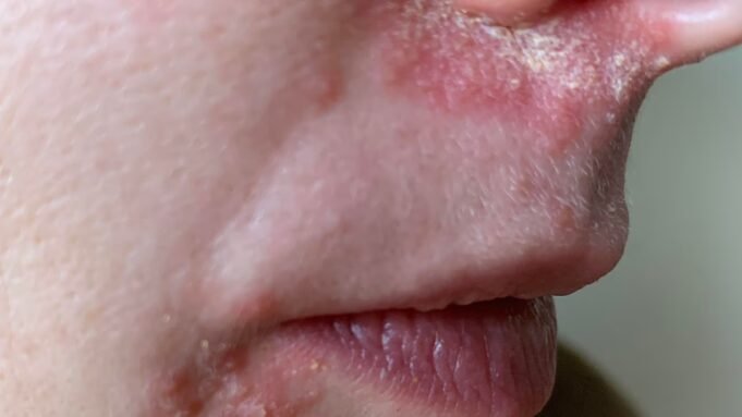 Αυτή η ελάχιστα γνωστή πάθηση του δέρματος κατέστρεψε τη ζωή μου. Δεν είναι ακμή, έκζεμα ή ακόμα και ροδόχρου ακμή - αλλά ένας συνδυασμός και των τριών που εμφανίζεται από το πουθενά και επηρεάζει χιλιάδες. Αυτά είναι τα σημάδια που πρέπει να προσέξετε - και πώς το αντιμετώπισα τελικά
| presscode.gr