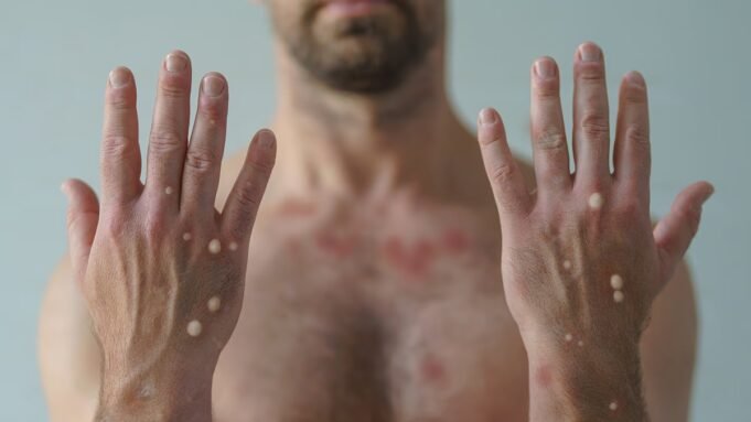 Επείγουσα προειδοποίηση για την αύξηση των πιο θανατηφόρων κρουσμάτων mpox Επείγουσα προειδοποίηση για την αύξηση των πιο θανατηφόρων κρουσμάτων mpox στην Ευρώπη και τις ΗΠΑ, καθώς οι βρετανοί αξιωματούχοι φοβούνται ότι ο ιός μπορεί να εξαπλωθεί απαρατήρητα
| presscode.gr