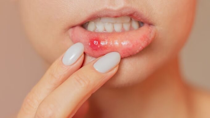 Πώς μπορώ να απαλλαγώ από αυτά τα φοβερά στοματικά έλκη που δεν τελειώνουν ποτέ; Η DR ELLIE έχει την απάντηση
| presscode.gr