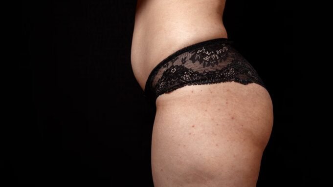 Υποφέρετε από κηλίδες στον αλήτη σας; Ένας ειδικός του δέρματος Υποφέρετε από κηλίδες στον αλήτη σας; Ένας ειδικός του δέρματος αποκαλύπτει την ελάχιστα γνωστή πάθηση πίσω από αυτό - και τι μπορείτε να κάνετε για να εξαφανίσετε αυτά τα αντιαισθητικά κόκκινα εξογκώματα
| presscode.gr